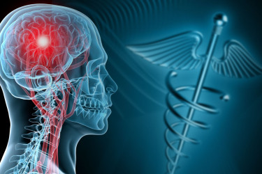 concussion